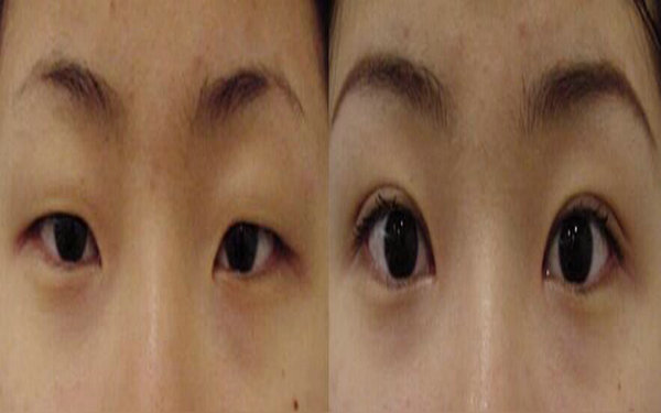 納米<a href=http://www.f3bb6.cn/listinfo-724-0.html target=_blank class=infotextkey>雙眼皮</a>保持幾年?