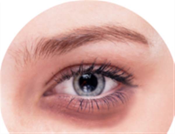 眼袋祛皺可以有效治療嗎