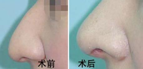 <a href=http://www.f3bb6.cn/listinfo-751-0.html target=_blank class=infotextkey>歪鼻矯正</a>術三大優(yōu)勢