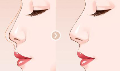 南京假體<a href=http://www.f3bb6.cn/listinfo-737-0.html target=_blank class=infotextkey>隆鼻</a>手術(shù)價(jià)格