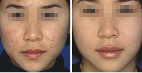 激光去痣有坑怎么辦?