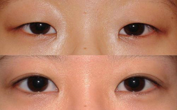 納米無痕和埋線的區別?