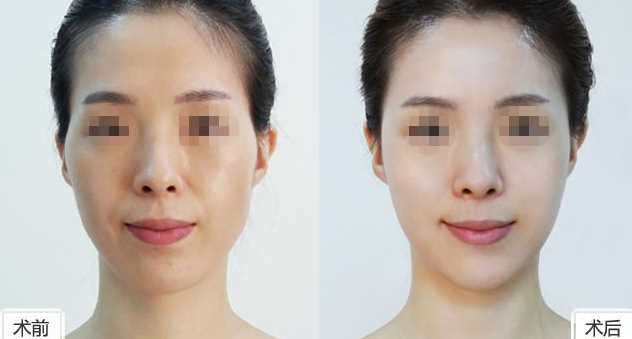 透明質(zhì)酸<a href=http://www.f3bb6.cn/listinfo-630-0.html target=_blank class=infotextkey>豐太陽穴</a>安全嗎