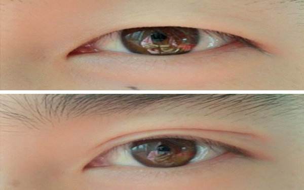 納米無痕<a href=http://www.f3bb6.cn/listinfo-724-0.html target=_blank class=infotextkey>雙眼皮</a>的缺點?