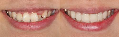 牙齒<a href=http://www.f3bb6.cn/listinfo-830-0.html target=_blank class=infotextkey>美容冠</a>的價格