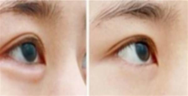 眼皮抽脂的術(shù)后效果怎么樣