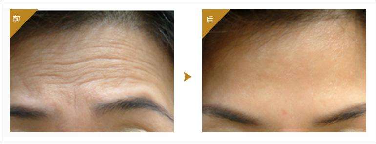 輕微的抬頭紋怎么去除