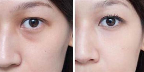 內切眼袋后遺癥