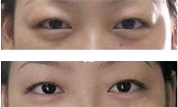 眼皮抽脂治療方法都有哪些
