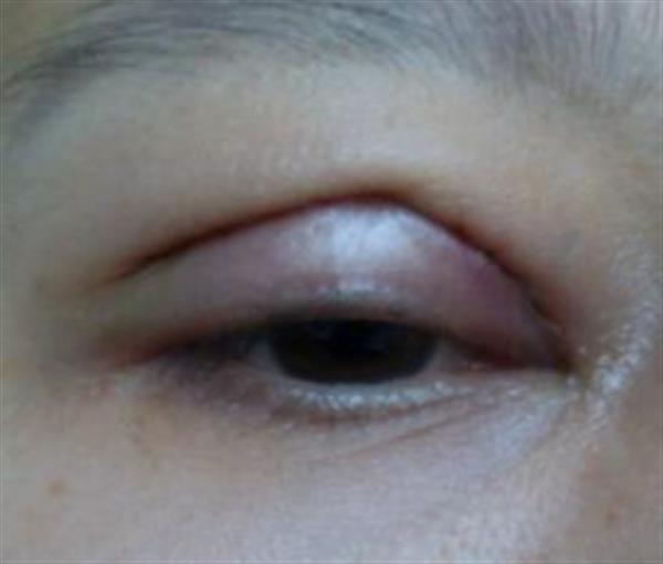眼皮抽脂的會不會引起眼皮下垂