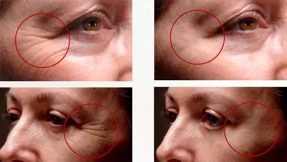 <a href=http://www.f3bb6.cn/listinfo-732-0.html target=_blank class=infotextkey>膠原蛋白注射</a>去皺價格