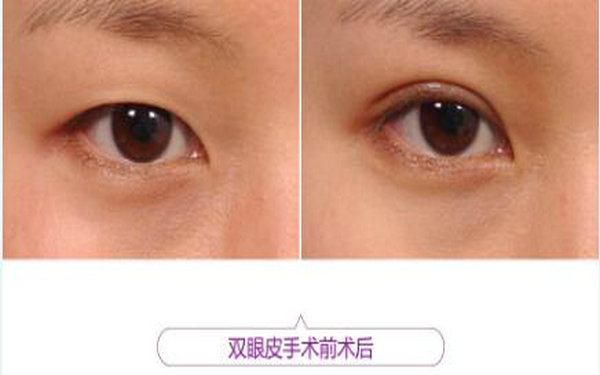 切開<a href=http://www.f3bb6.cn/listinfo-724-0.html target=_blank class=infotextkey>雙眼皮</a>幾天拆線?