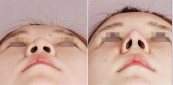 <a href=http://www.f3bb6.cn/listinfo-737-0.html target=_blank class=infotextkey>隆鼻</a>子長期性的多少錢