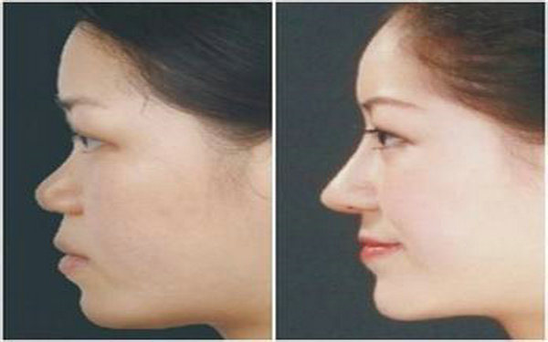 哪款透明質酸適合打鼻子?