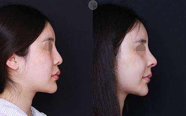 異體肋骨<a href=http://www.f3bb6.cn/listinfo-737-0.html target=_blank class=infotextkey>隆鼻</a>