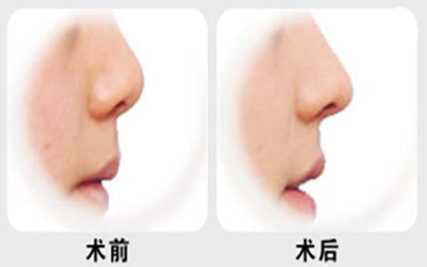 自體肋骨<a href=http://www.f3bb6.cn/listinfo-737-0.html target=_blank class=infotextkey>隆鼻</a>