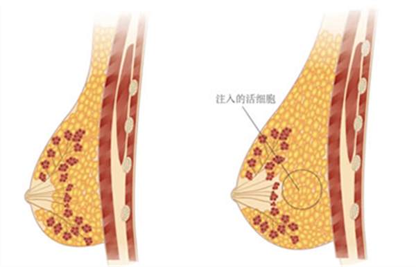 復合<a href=http://www.f3bb6.cn/listinfo-618-0.html target=_blank class=infotextkey>隆胸</a>的好處