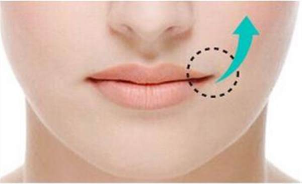 嘴角上揚(yáng)手術(shù)價(jià)格