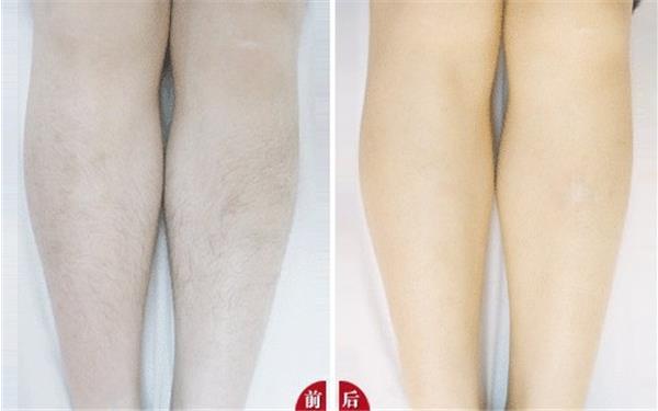 e光<a href=http://www.f3bb6.cn/listinfo-670-0.html target=_blank class=infotextkey>脫毛</a>有副作用嗎