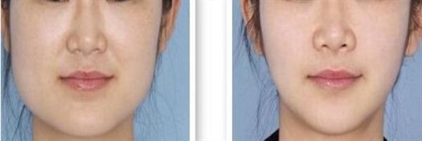 打<a href=http://www.f3bb6.cn/listinfo-631-0.html target=_blank class=infotextkey>瘦臉</a><a href=http://www.f3bb6.cn/listinfo-614-0.html target=_blank class=infotextkey>除皺</a>到底好不好