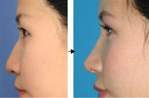 上顎骨整形手術危險嗎