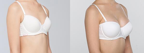 常用的<a href=http://www.f3bb6.cn/listinfo-618-0.html target=_blank class=infotextkey>隆胸</a>手術方法有哪些？