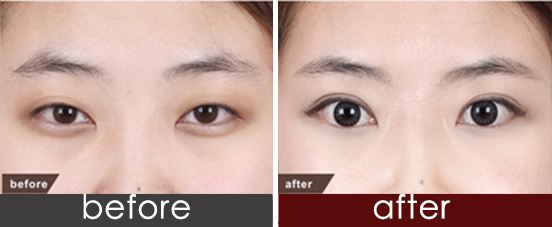 全切<a href=http://www.f3bb6.cn/listinfo-724-0.html target=_blank class=infotextkey>雙眼皮</a>多久能化妝