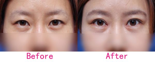 割<a href=http://www.f3bb6.cn/listinfo-724-0.html target=_blank class=infotextkey>雙眼皮</a>開不<a href=http://www.f3bb6.cn/listinfo-711-0.html target=_blank class=infotextkey>開眼角</a>