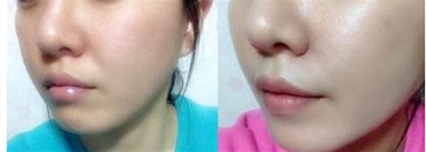 自體脂肪<a href=http://www.f3bb6.cn/listinfo-647-0.html target=_blank class=infotextkey>豐臉頰</a>好不好