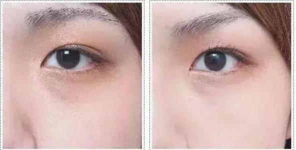 超聲波<a href=http://www.f3bb6.cn/listinfo-708-0.html target=_blank class=infotextkey>去眼袋</a>安全嗎