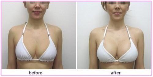 自脂豐胸需要多少錢?