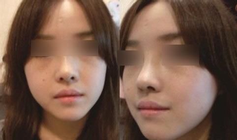 縮小鼻子手術多少錢