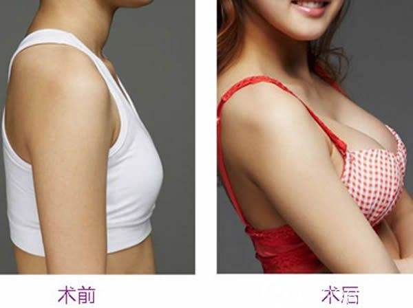 自體脂肪<a href=http://www.f3bb6.cn/listinfo-618-0.html target=_blank class=infotextkey>隆胸</a>長期的嗎