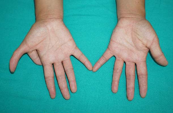 手指矯正手術多少錢