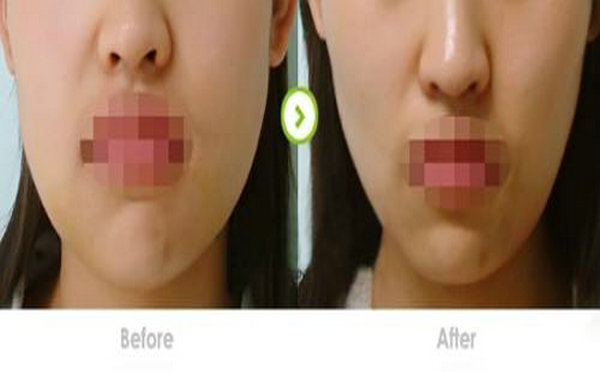 面部光纖<a href=http://www.f3bb6.cn/listinfo-682-0.html target=_blank class=infotextkey>溶脂</a>效果好嗎?