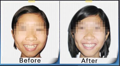 牙齒骨性反頜怎么矯正