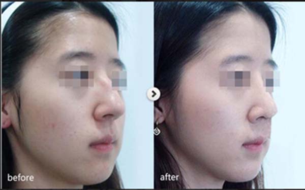 假體<a href=http://www.f3bb6.cn/listinfo-737-0.html target=_blank class=infotextkey>隆鼻</a>手術可以保持多久