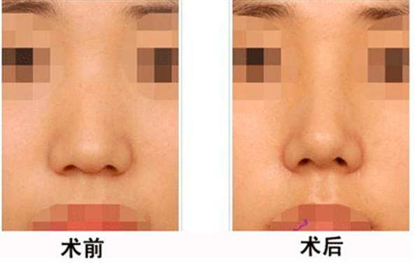 透明質酸<a href=http://www.f3bb6.cn/listinfo-737-0.html target=_blank class=infotextkey>隆鼻</a>的效果