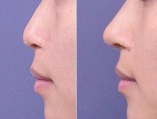 假體<a href=http://www.f3bb6.cn/listinfo-737-0.html target=_blank class=infotextkey>隆鼻</a>歪了如何補救