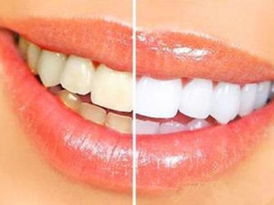 超聲波洗牙的價格大概多少錢