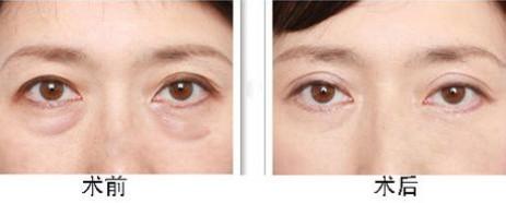 超聲波<a href=http://www.f3bb6.cn/listinfo-708-0.html target=_blank class=infotextkey>去眼袋</a>手術(shù)好不好 大概需要多少錢(qián)