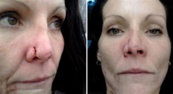 透明質酸<a href=http://www.f3bb6.cn/listinfo-737-0.html target=_blank class=infotextkey>隆鼻</a>失敗的樣子案例圖