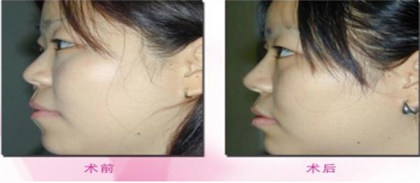 透明質(zhì)酸<a href=http://www.f3bb6.cn/listinfo-737-0.html target=_blank class=infotextkey>隆鼻</a>前后效果對比圖