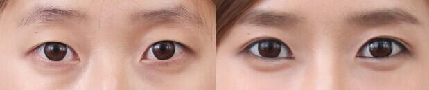 超聲波<a href=http://www.f3bb6.cn/listinfo-708-0.html target=_blank class=infotextkey>去眼袋</a>后眼眶塌陷有什么辦法恢復