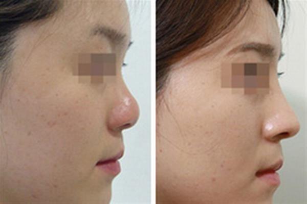 <a href=http://www.f3bb6.cn/listinfo-737-0.html target=_blank class=infotextkey>隆鼻</a>需要花多少錢