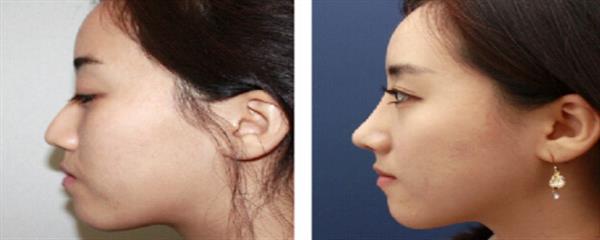 透明質(zhì)酸<a href=http://www.f3bb6.cn/listinfo-737-0.html target=_blank class=infotextkey>隆鼻</a>案例對比圖