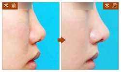 <a href=http://www.f3bb6.cn/listinfo-751-0.html target=_blank class=infotextkey>歪鼻矯正</a>手術的優點是什么