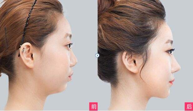 保定<a href=http://www.f3bb6.cn/listinfo-737-0.html target=_blank class=infotextkey>隆鼻</a>哪里好