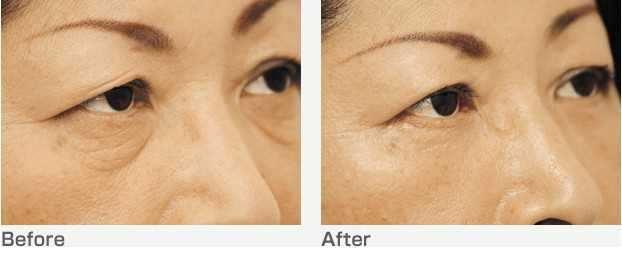 三角眼整形可以通過(guò)哪些手術(shù)方式？