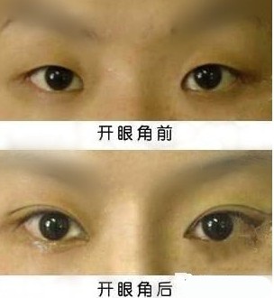 <a href=http://www.f3bb6.cn/listinfo-711-0.html target=_blank class=infotextkey>開眼角</a>手術修復哪里好